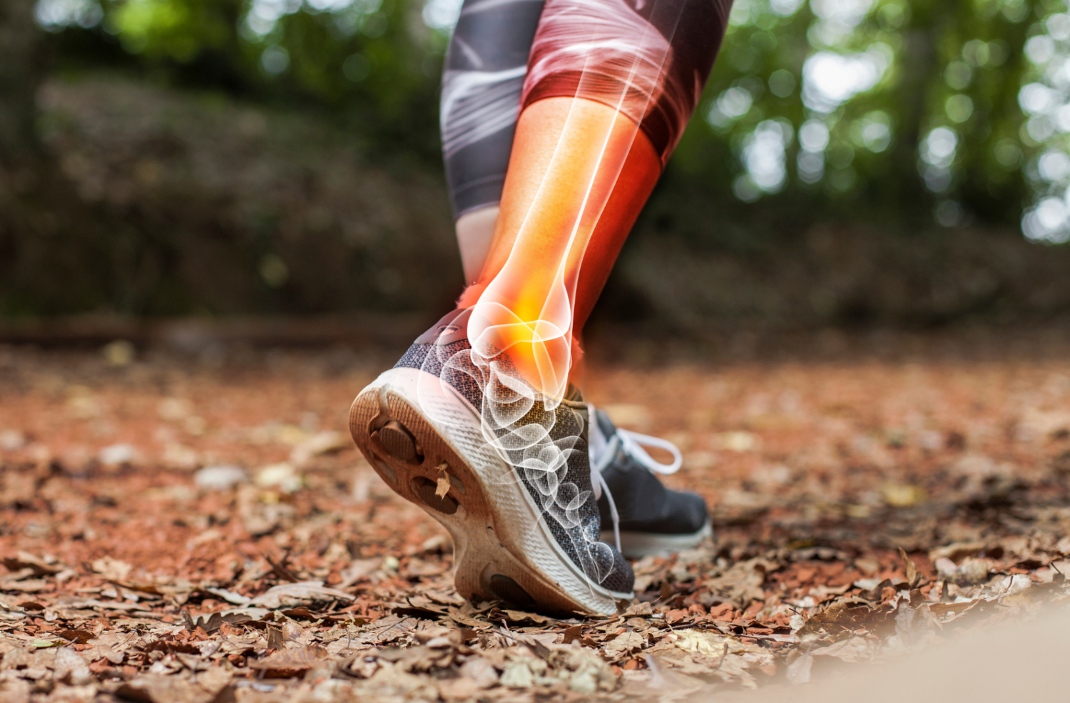 Bone Stress Injuries vs. Tendon-Related Pathologies in Runners - Crew ...